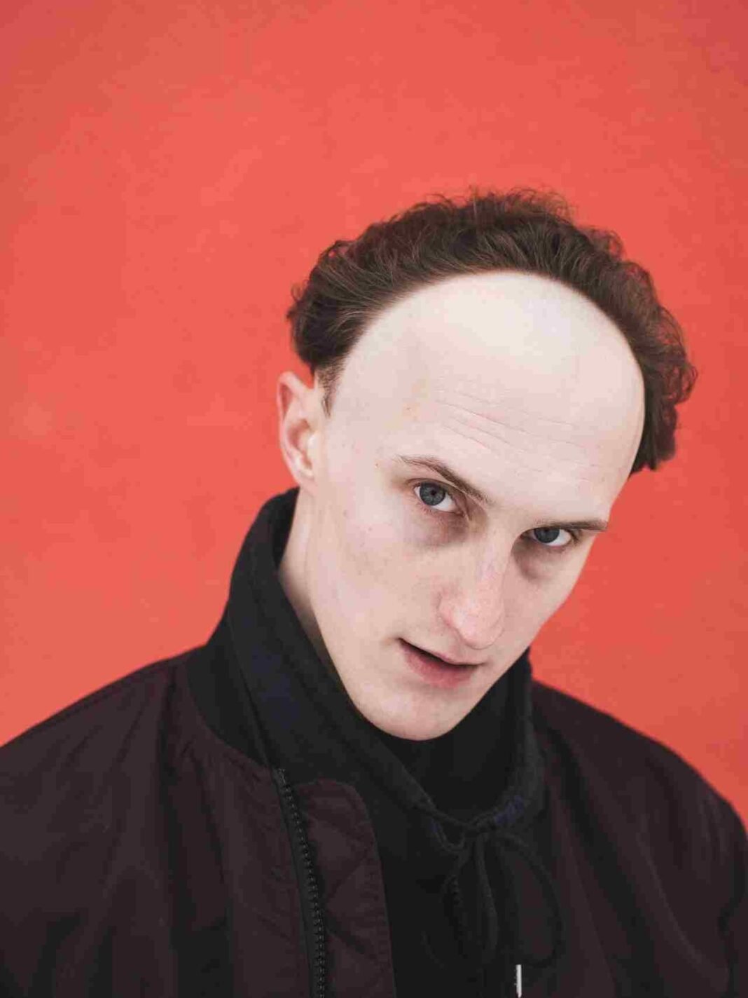 Need To Know Before Getting A Hair Transplant