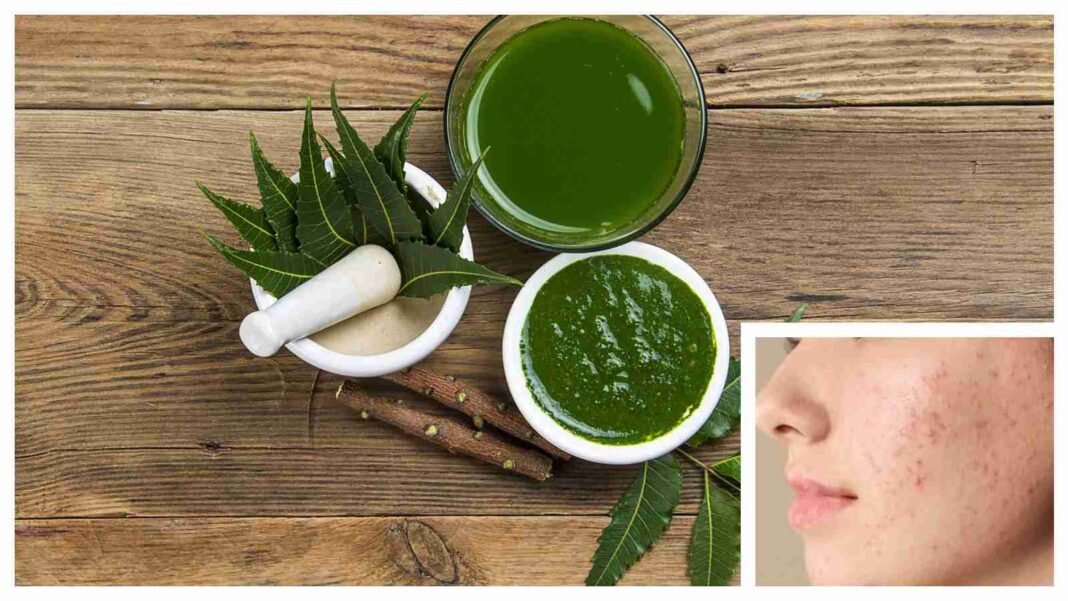 NEEMforPimples.jpeg How to use neem to reduce acne and acne without destroying your skin
